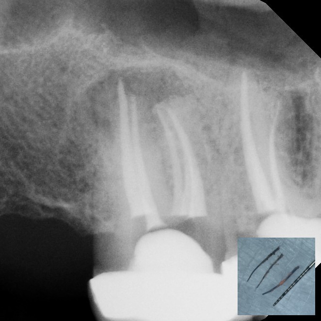 After Endodontic Treatment Case 2 - Harp Endodontics Manhattan New York